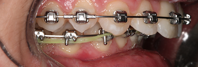 Jaw Surgery