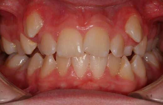 Invisalign Invisalign
