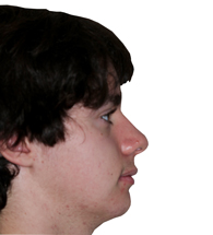 Jaw Surgery