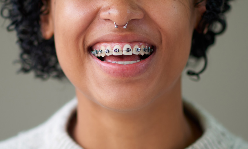 metal braces
