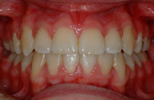 Invisalign Invisalign
