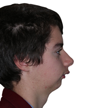 Jaw Surgery